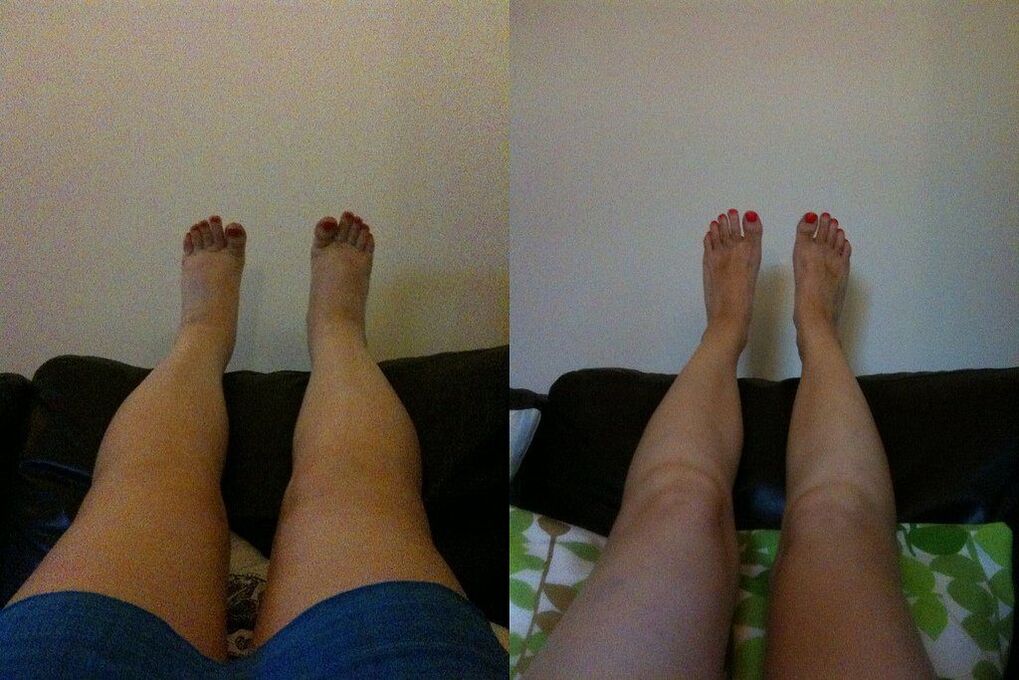 Effective result before and after applying Ostelife Premium Plus cream from Margarita