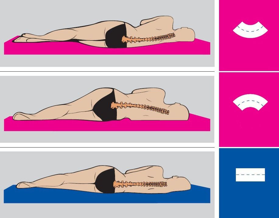 Correct body position during sleep with lumbar osteochondrosis