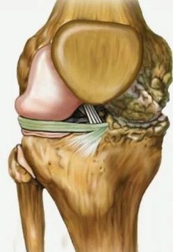 Arthrosis of the knee joint