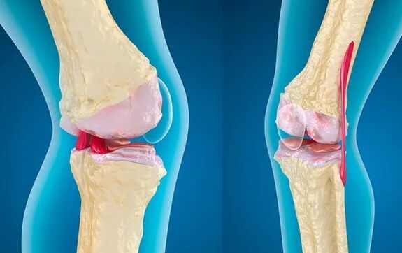 Gonarthrosis of 3 degrees of knee joints