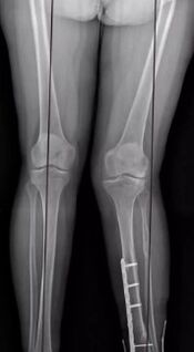 Knee deformations