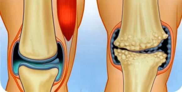 The normal condition of the joint and the causes of the development of arthrosis of the knee