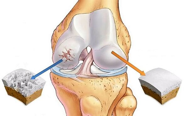 norm and deviation for arthrosis of the knee joint
