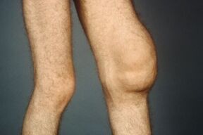 The causes and symptoms of arthrosis of the knee joint