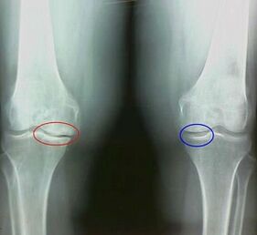 The result of the treatment of arthritis and arthrosis folk remedies