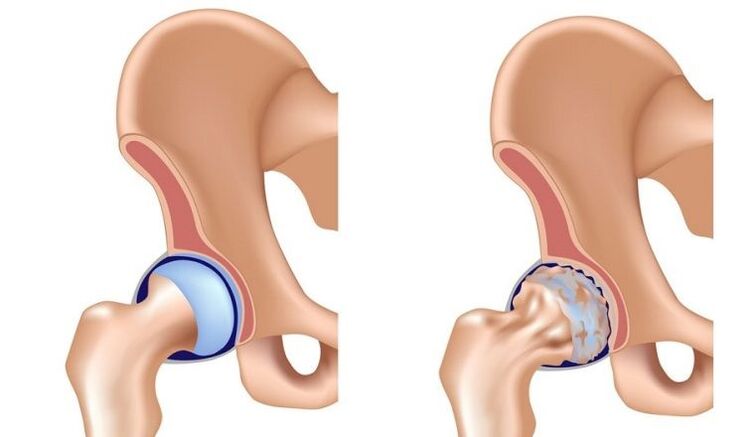 Healthy and joint with arthrosis