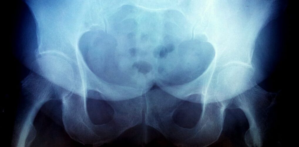 X -ray picture with arthrosis of the 2nd degree